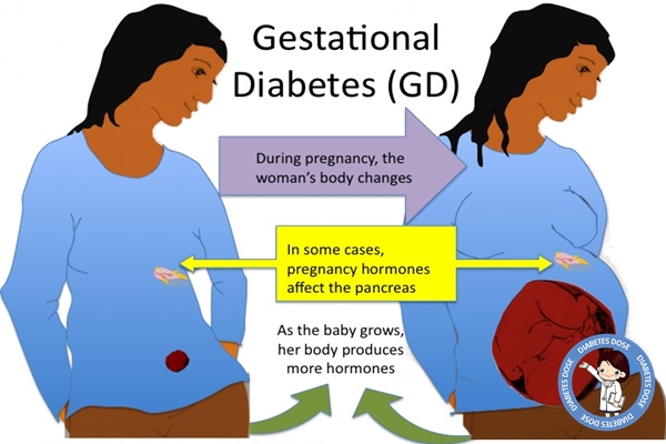 Understanding the Causes of Diabetes: What Food Causes Diabetes