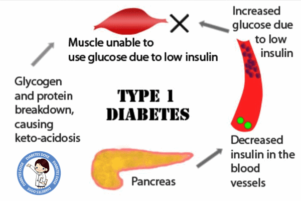 What is Type 1 Diabetes, Symptoms, Warning Signs, Causes, Treatment, Cure